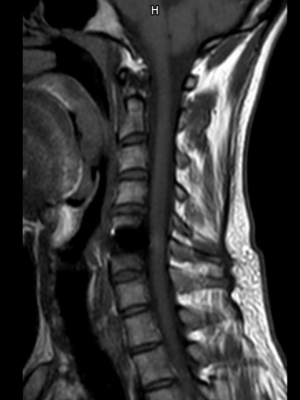Limited MRI artefacts