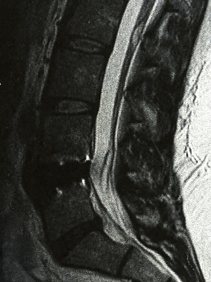 Limited MRI artifacts