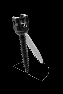 Tornillo 25D específico para la deformidad