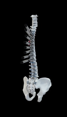 Translation technique with tower reducers