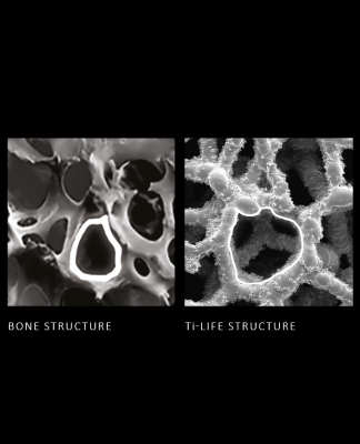 Ti-LIFE vs bone structure 